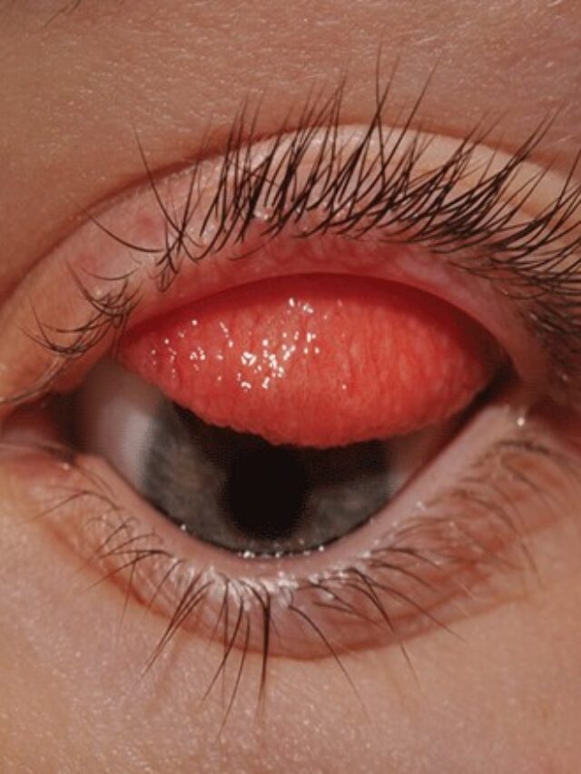 Eye Flu Types & Treatment