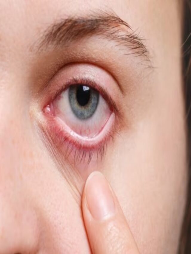 Home remedies to prevent eye flu