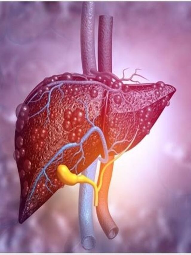 Tips to help manage and improve Fatty Liver